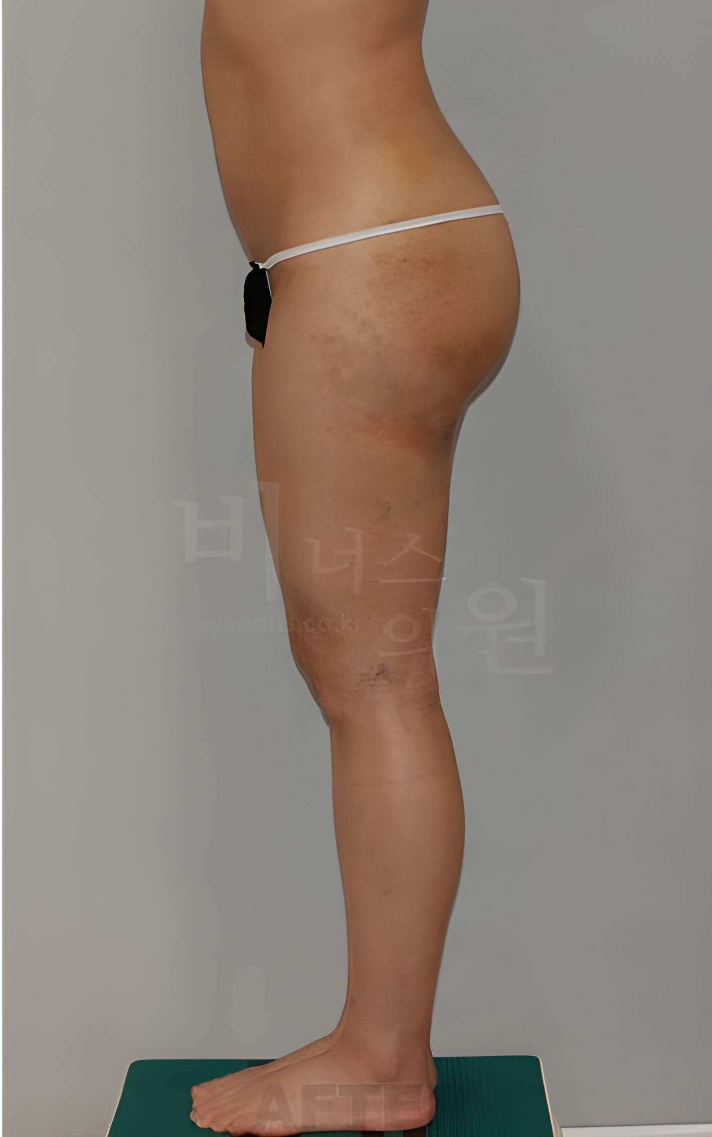 엉덩이 애플라인 지방흡입 수술 후 측면
