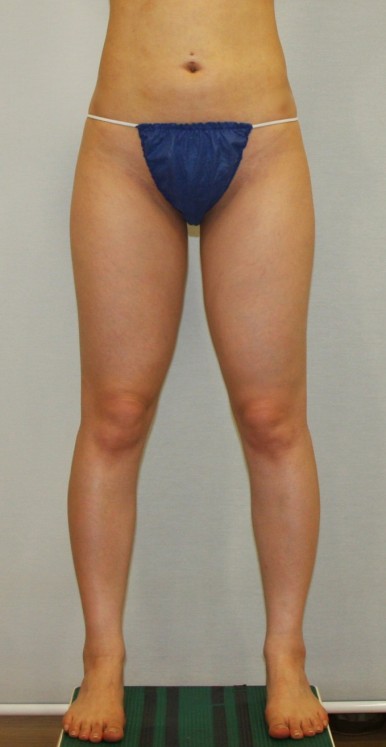 허벅지지방흡입 수술 전 벌림 모습.jpg