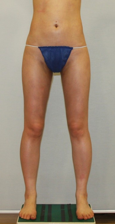 허벅지지방흡입 수술 후 벌림 모습.jpg