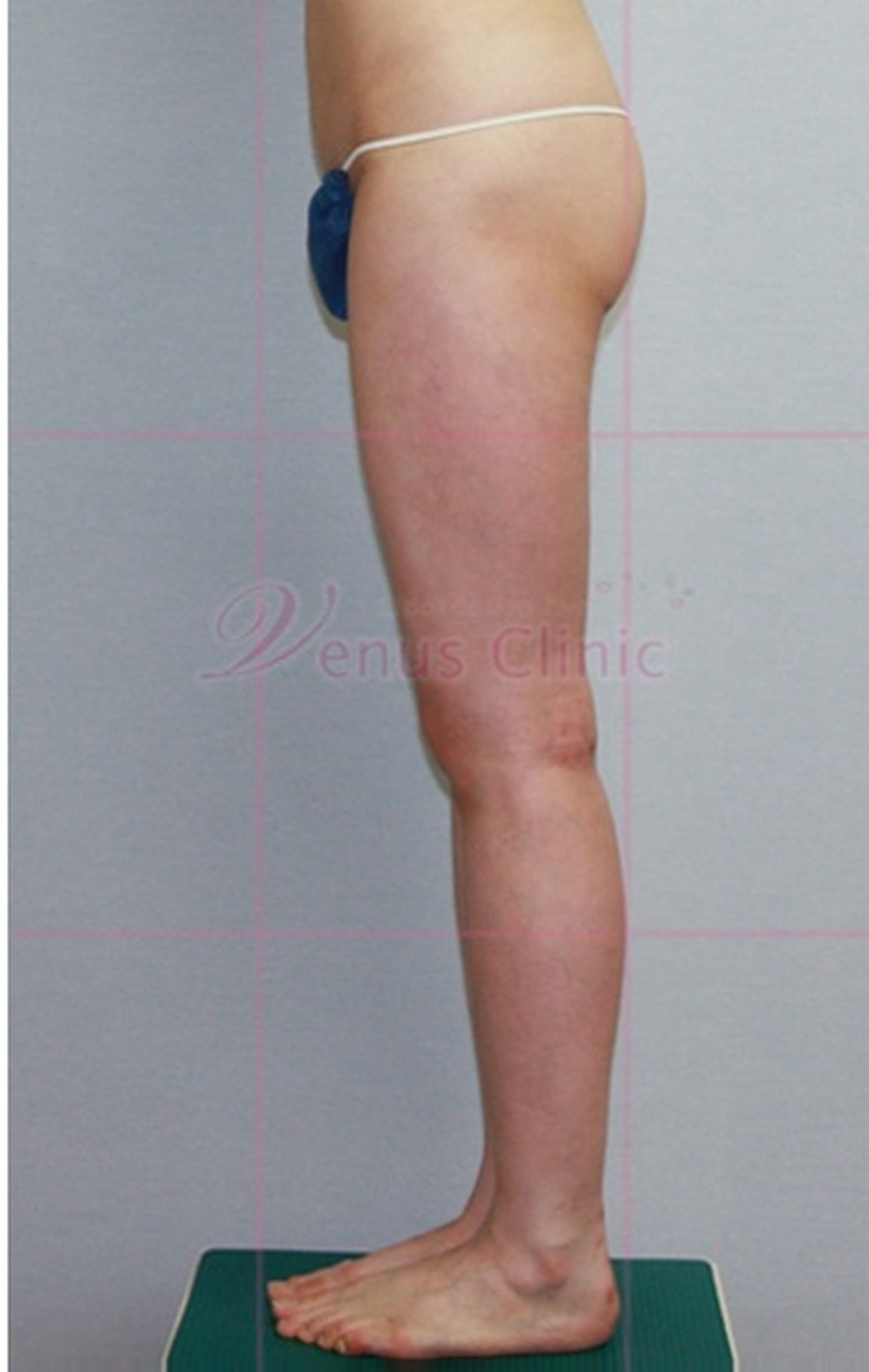 엉덩이 볼륨업 지방흡입 수술 후 측면 엉덩이 외측 라인 변화 비너스의원