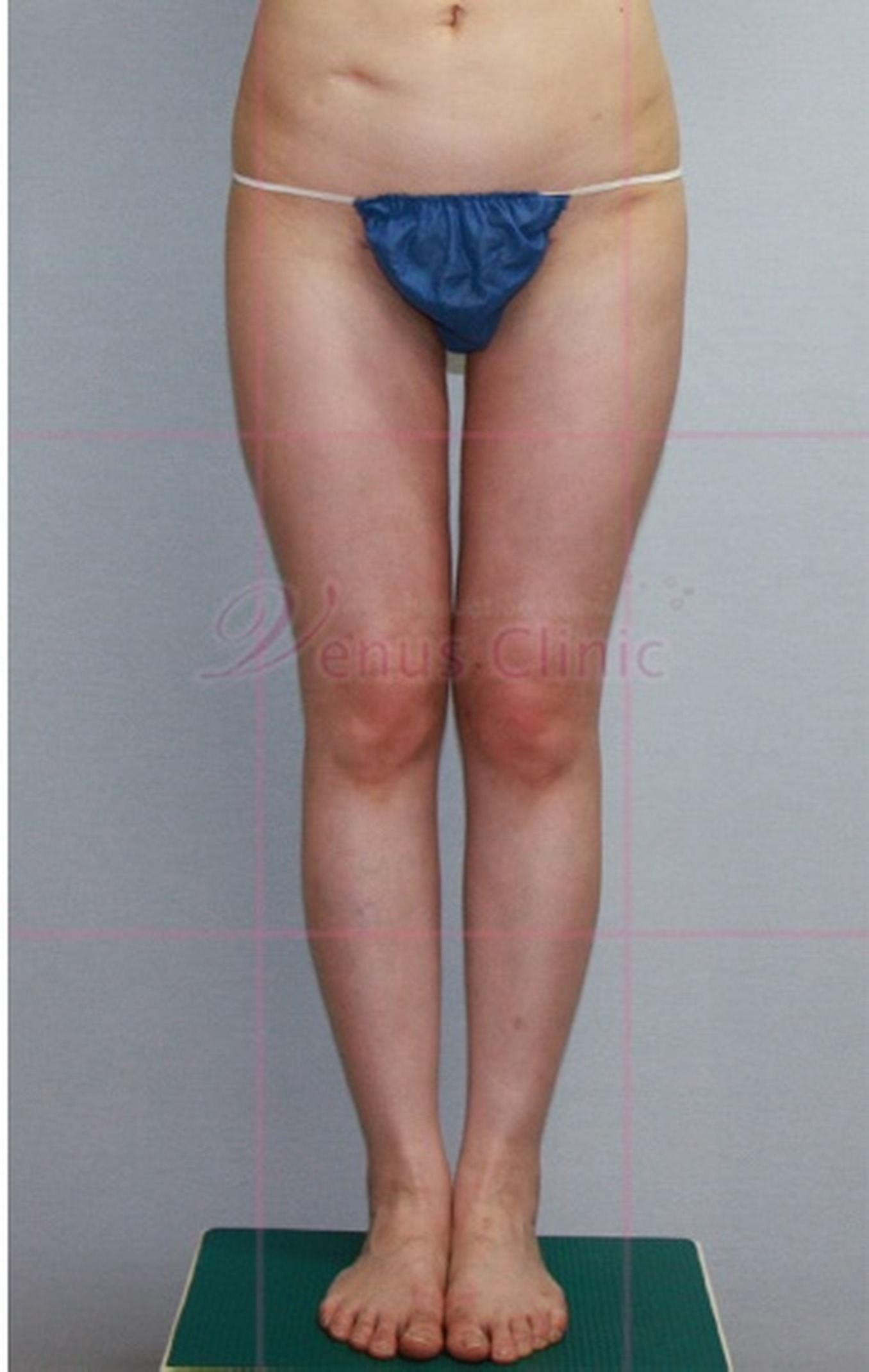 엉덩이 볼륨업 지방흡입 수술 후 정면 하반신 체형 변화 비너스의원