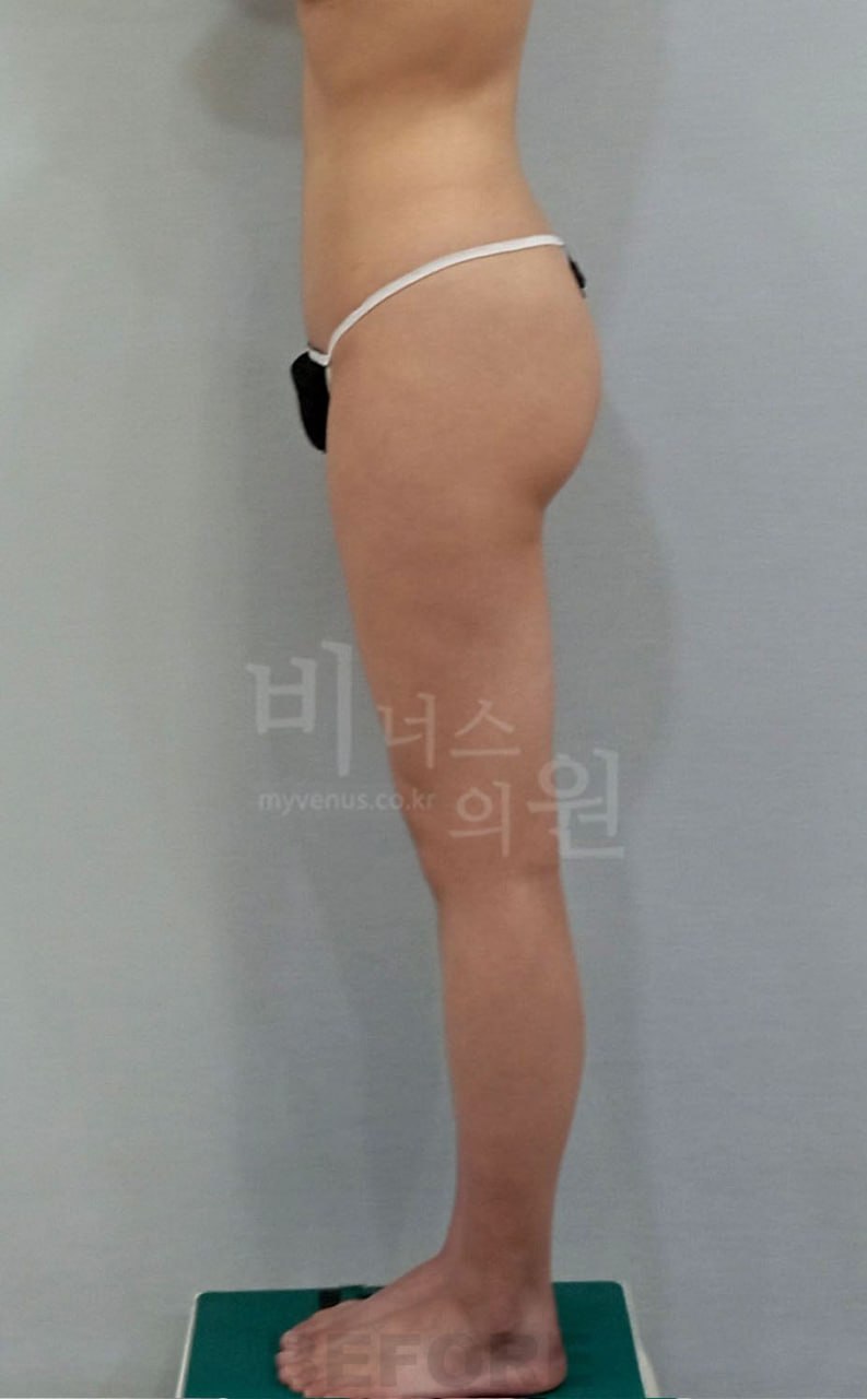 엉덩이 지방흡입 수술 전 측면 비너스의원