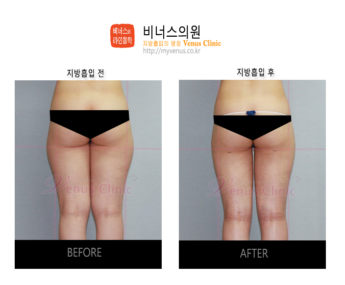 부천지방흡입 (4).jpg