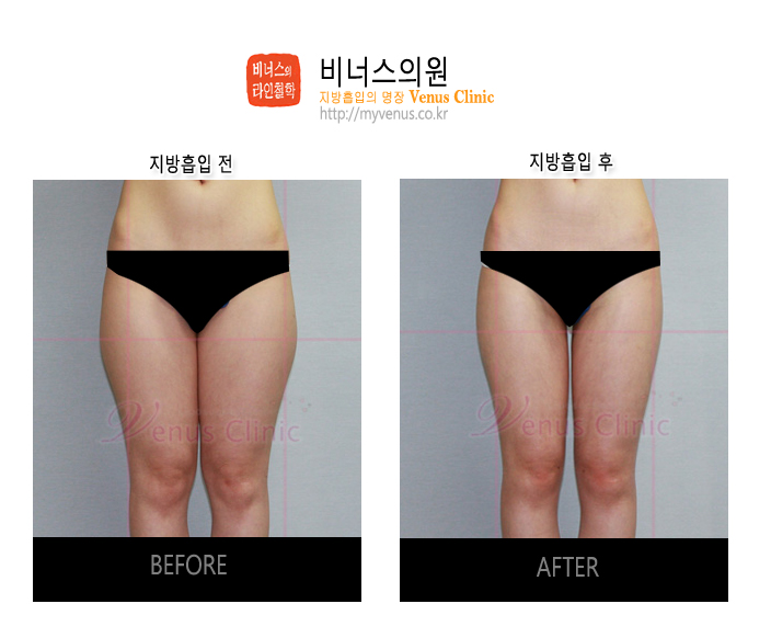 부천지방흡입 (1).jpg