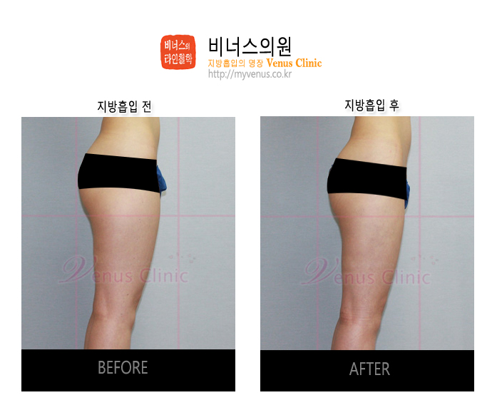 부천지방흡입 (3).jpg