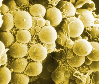 지방흡입 다이어트차이 (5).jpg