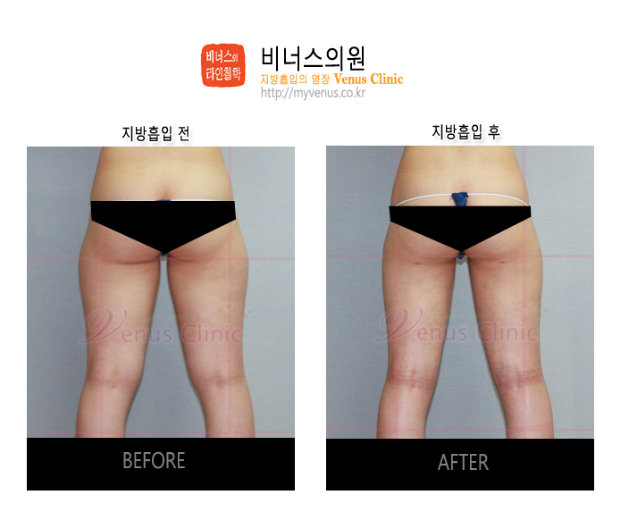 부천지방흡입 (5).jpg
