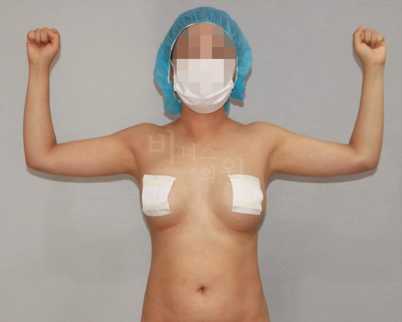 팔뚝 지방흡입 정면 수술 후