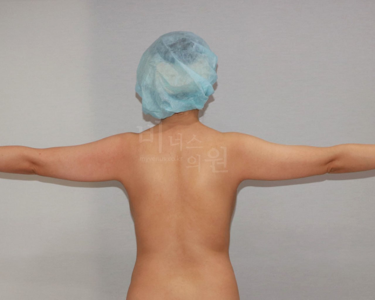 팔뚝 지방흡입 후면 수술 전