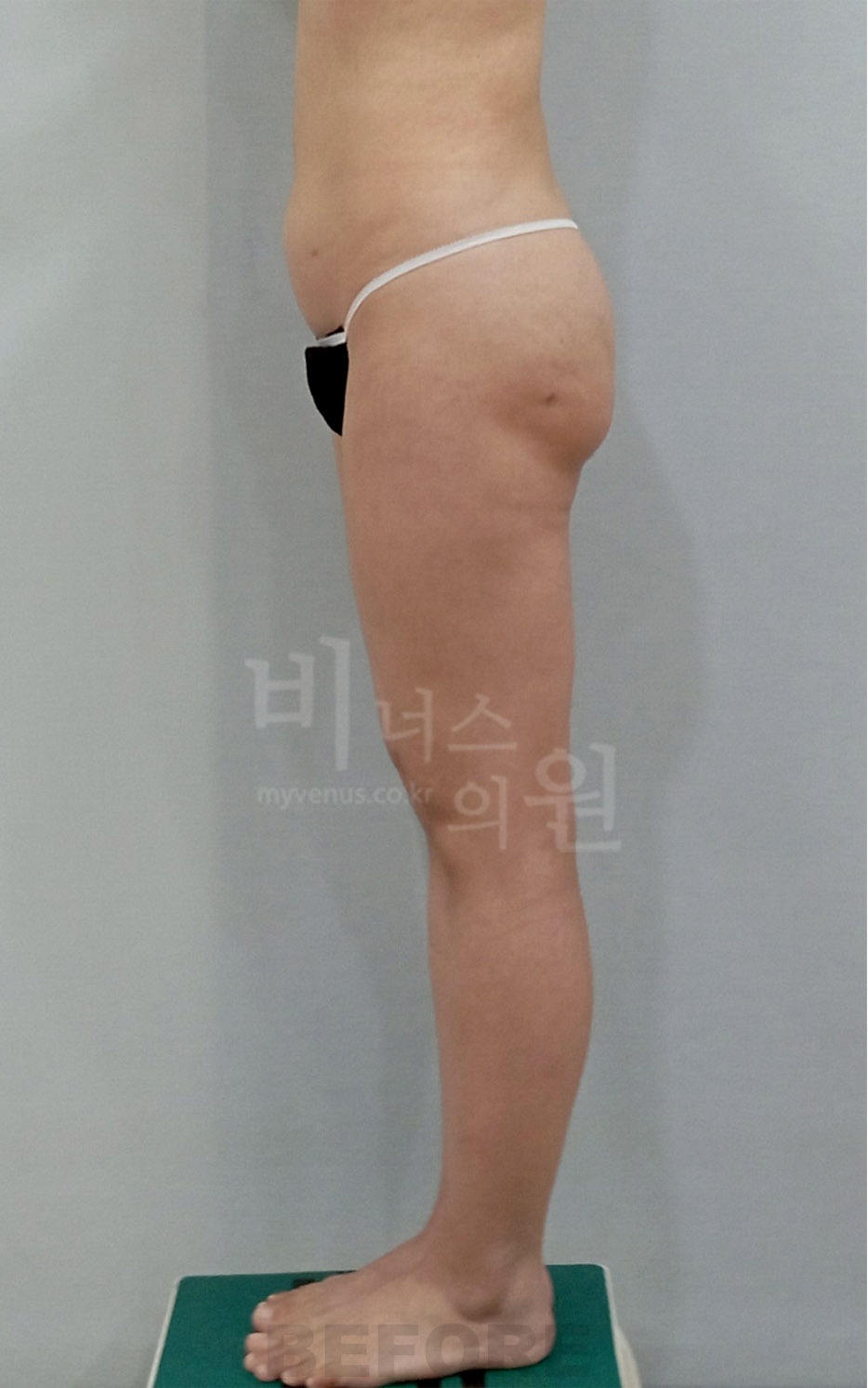엉덩이처짐 지방흡입 수술 전 측면 비너스의원