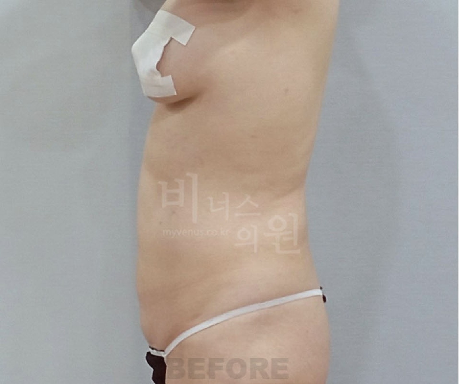 복부 지방흡입 수술 전 측면 비너스의원