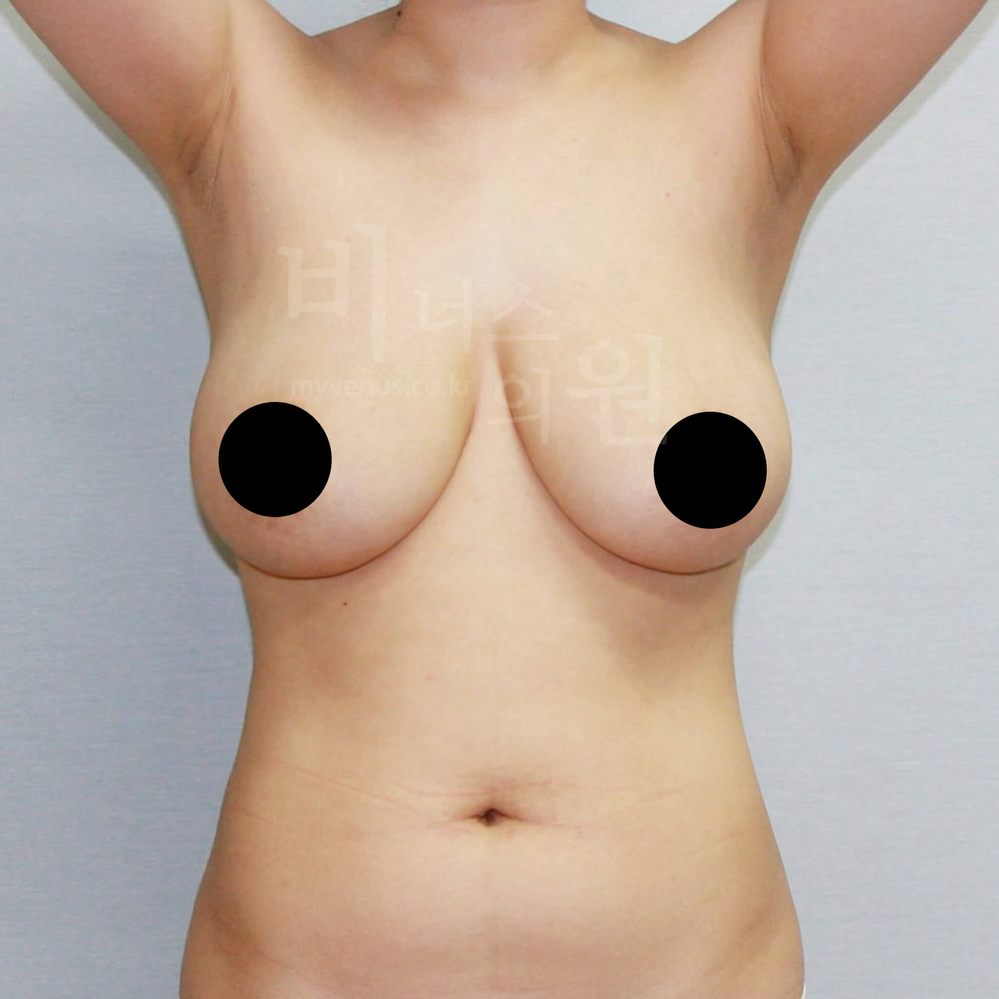 가슴축소 지방흡입 수술 전 정면