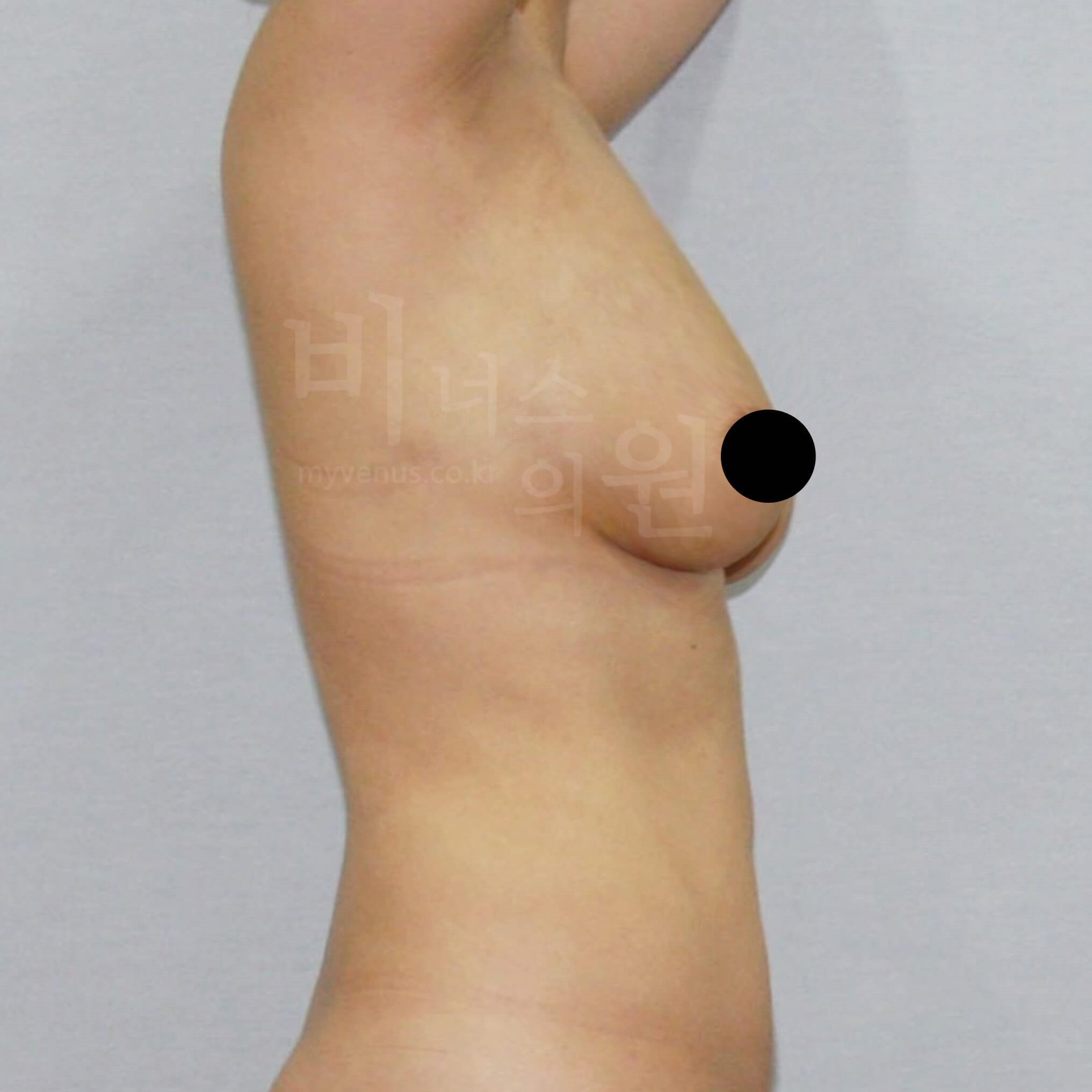 가슴축소 지방흡입 수술 전 측면