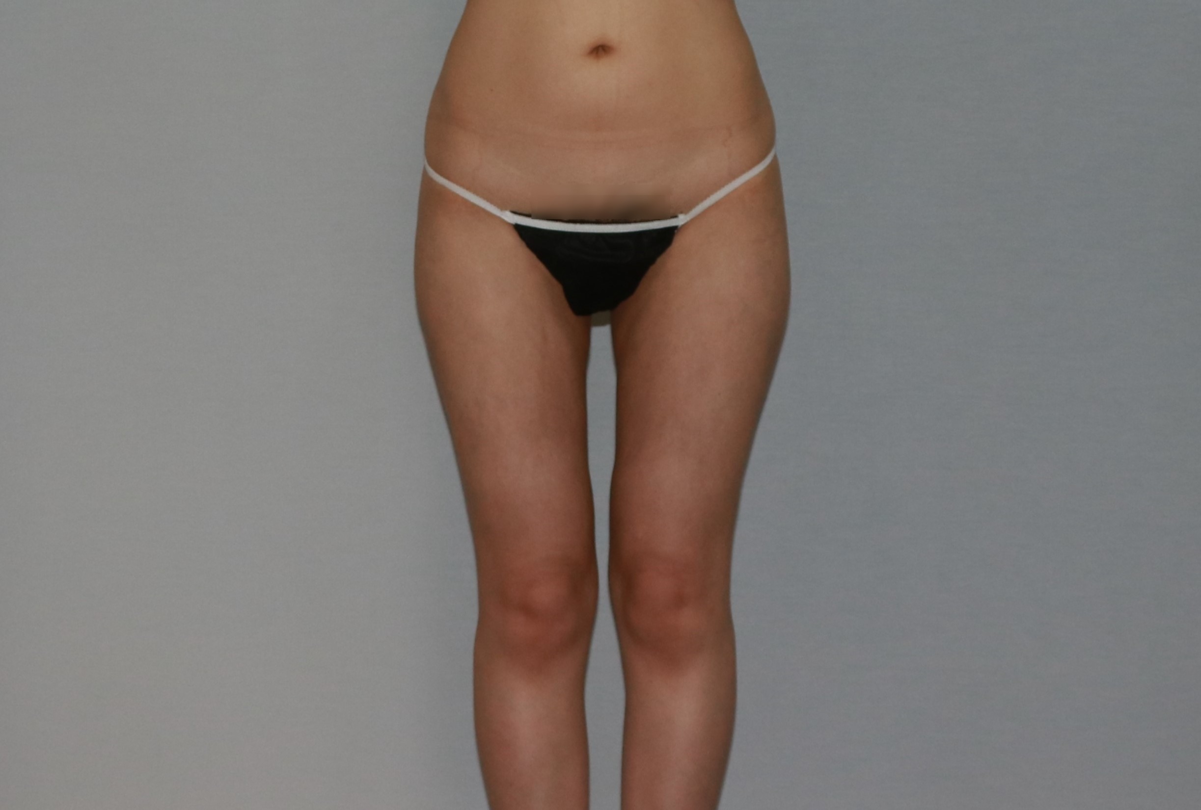 허벅지 한달 경과.JPG