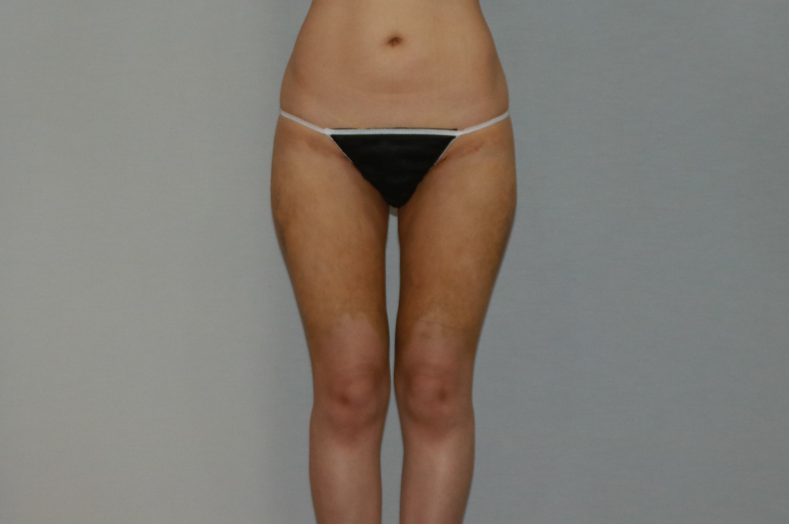 허벅지 후기.JPG