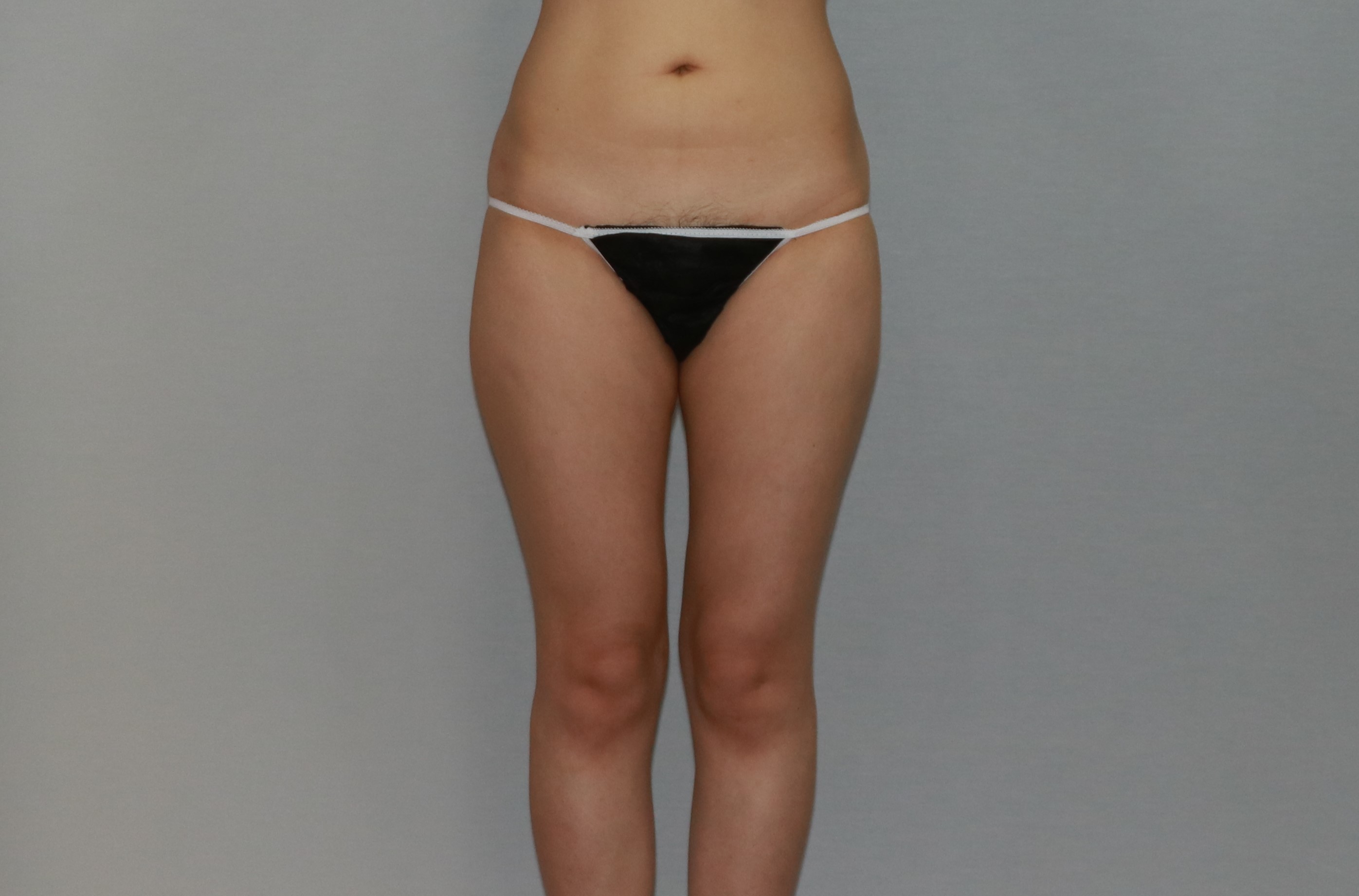 허벅지 지방흡입.JPG