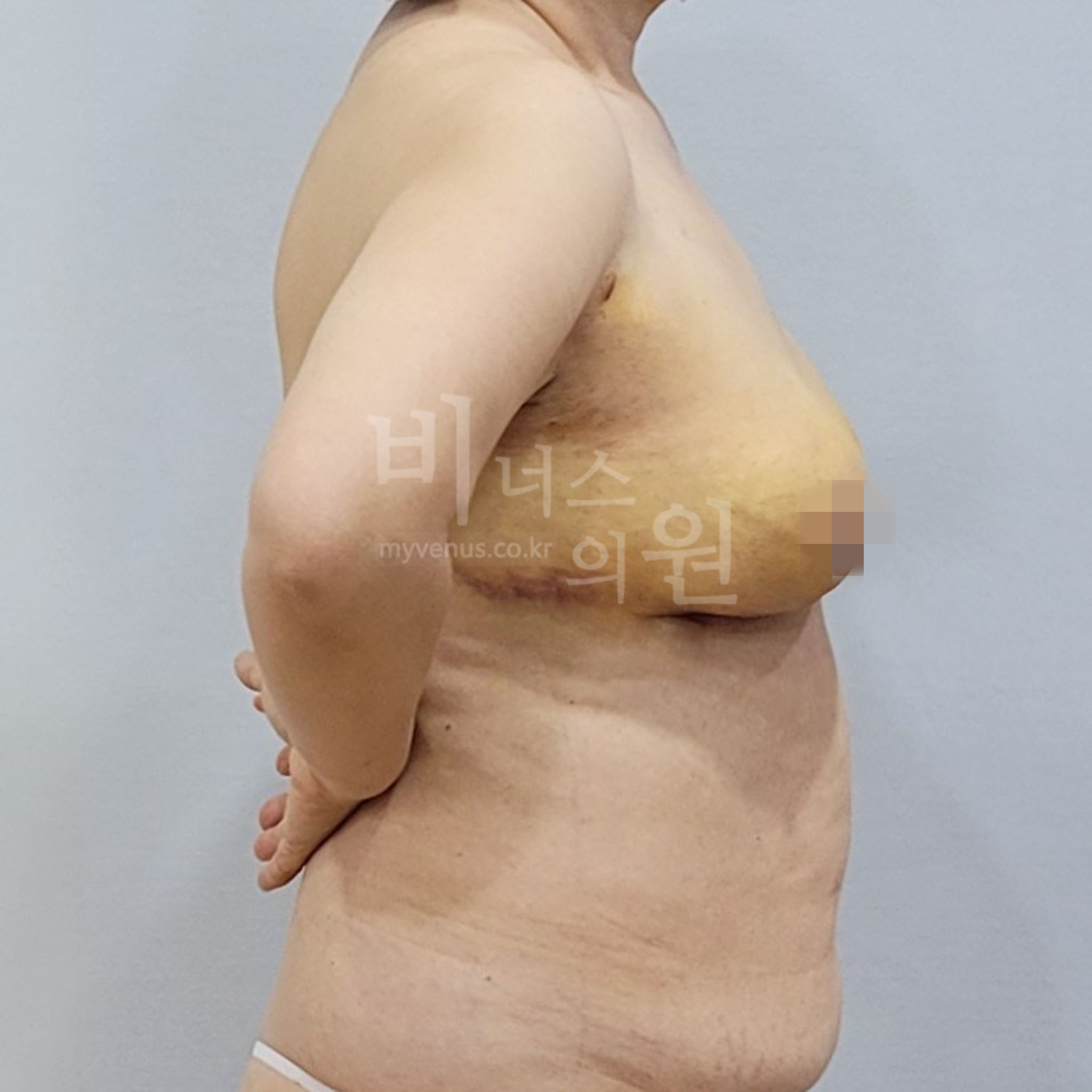 가슴축소 지방흡입 수술 후 측면 자세 비너스의원