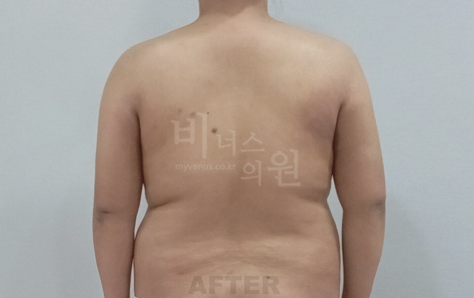 팔 지방흡입 수술 후 후면 차렷 자세 비너스의원