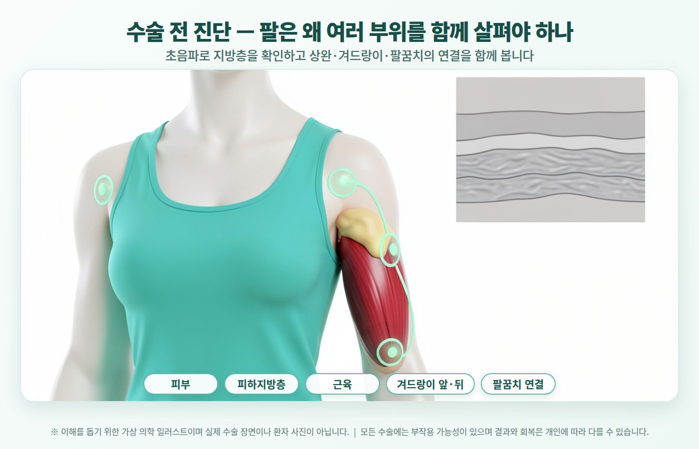 팔 지방흡입 진단 시 확인하는 겨드랑이 앞뒤 부위 비교 인포그래픽