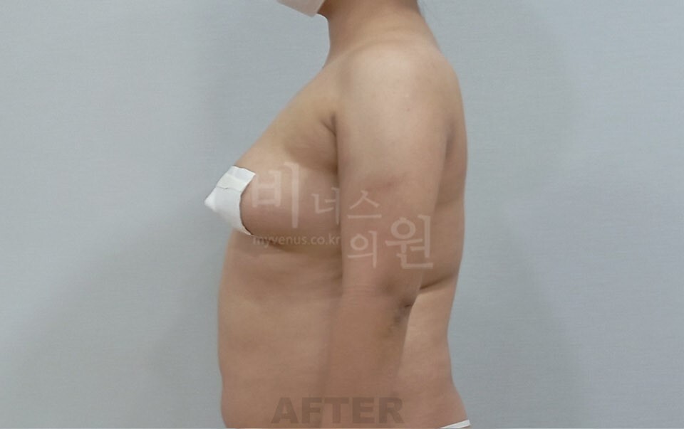 팔 지방흡입 수술 후 우측면 비너스의원