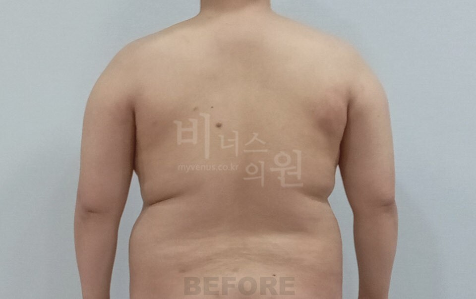 팔 지방흡입 수술 전 후면 차렷 자세 비너스의원