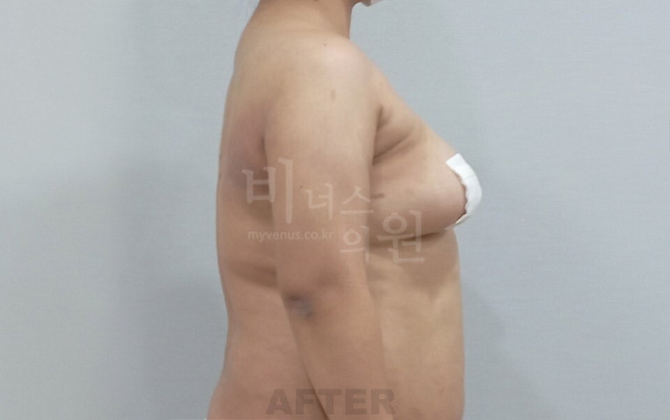 팔 지방흡입 수술 후 좌측면 비너스의원