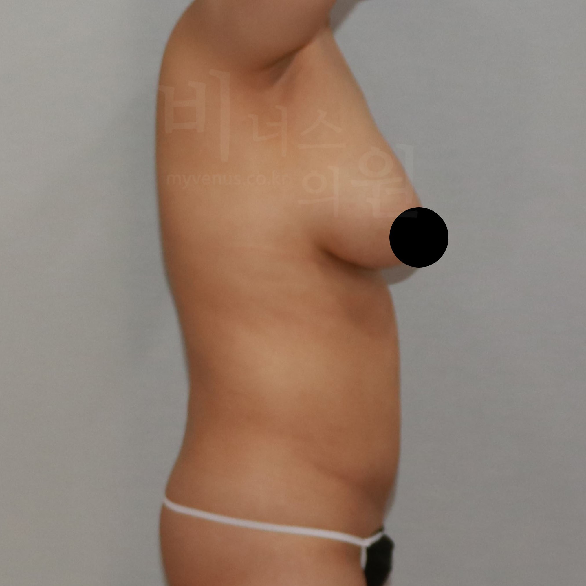 가슴축소 지방흡입 수술 전 측면