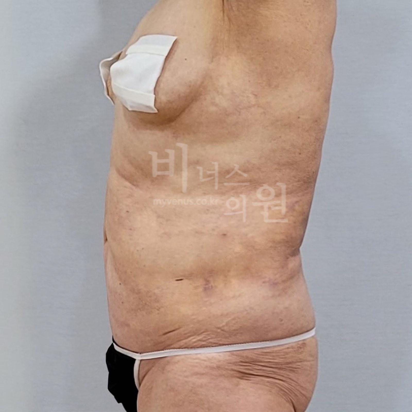 복부 지방흡입 수술후 우측면 비너스의원