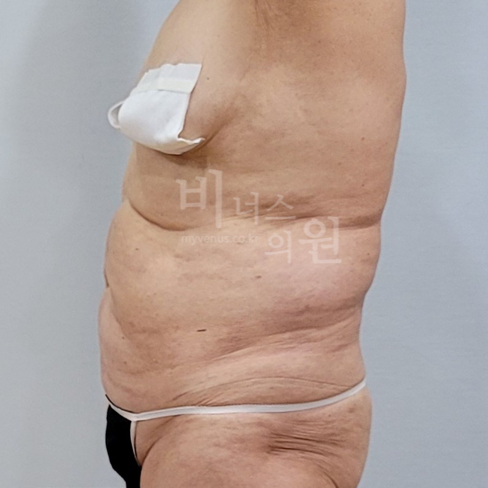 복부 지방흡입 수술전 우측면 비너스의원
