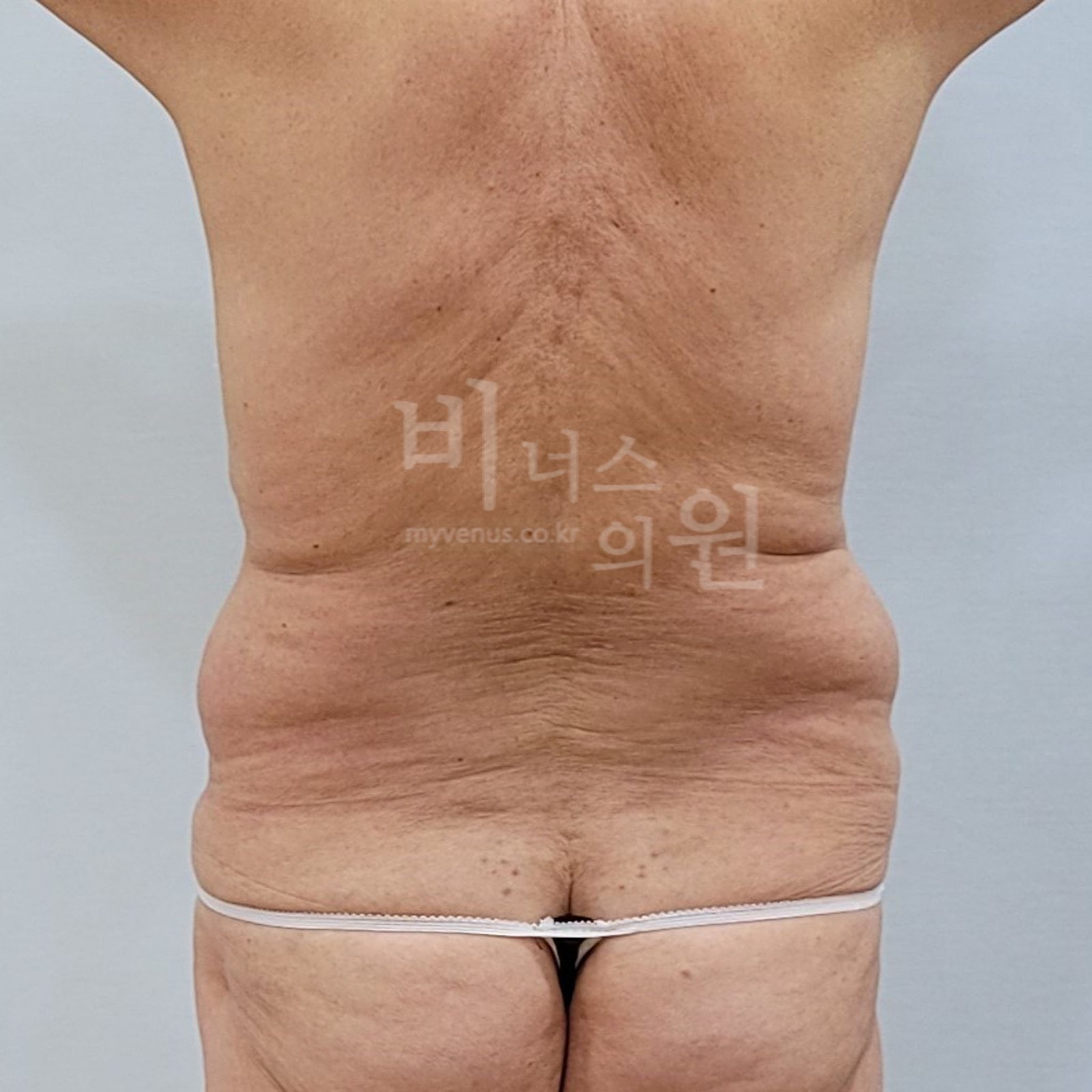 복부 지방흡입 수술전 후면 비너스의원