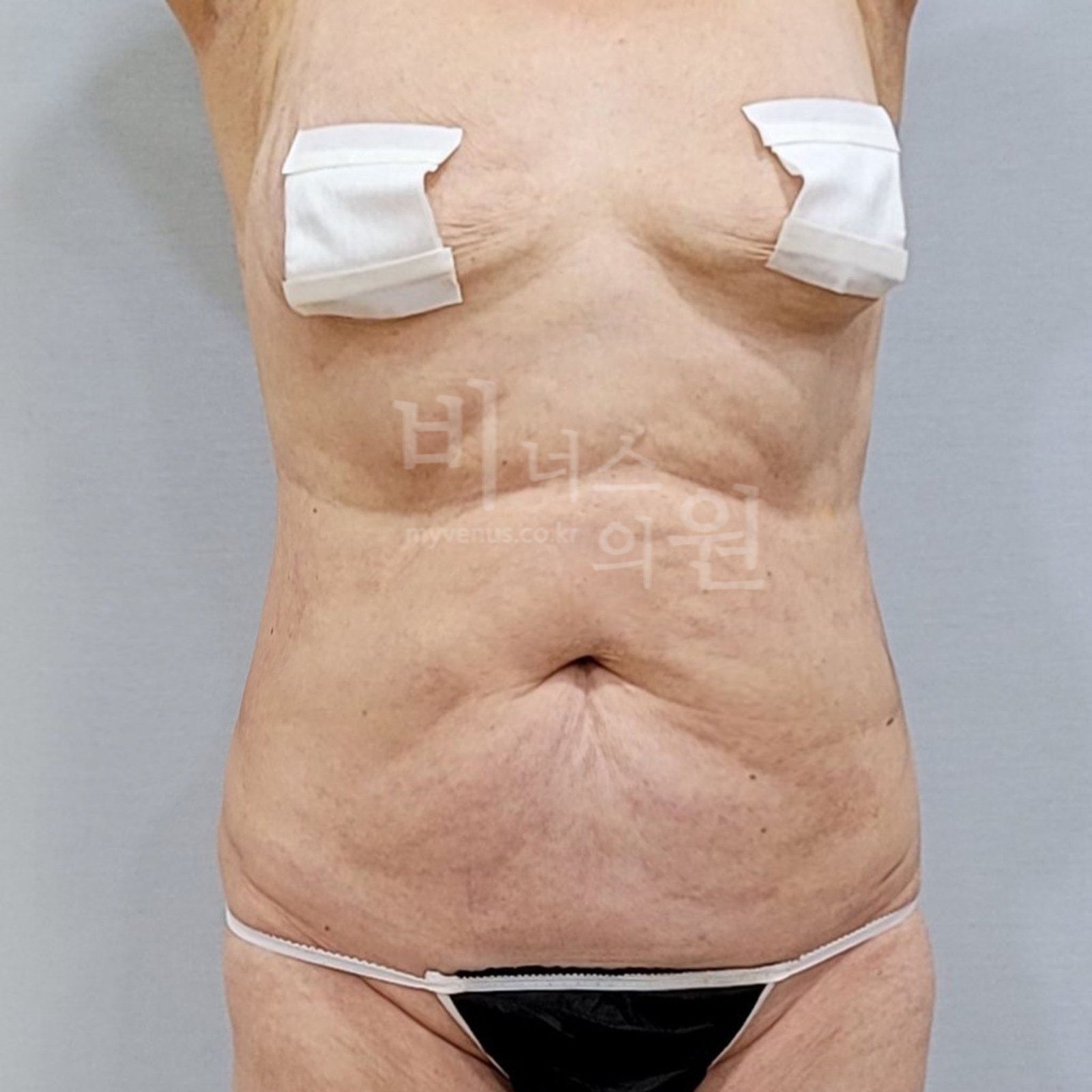 복부 지방흡입 수술후 정면 비너스의원