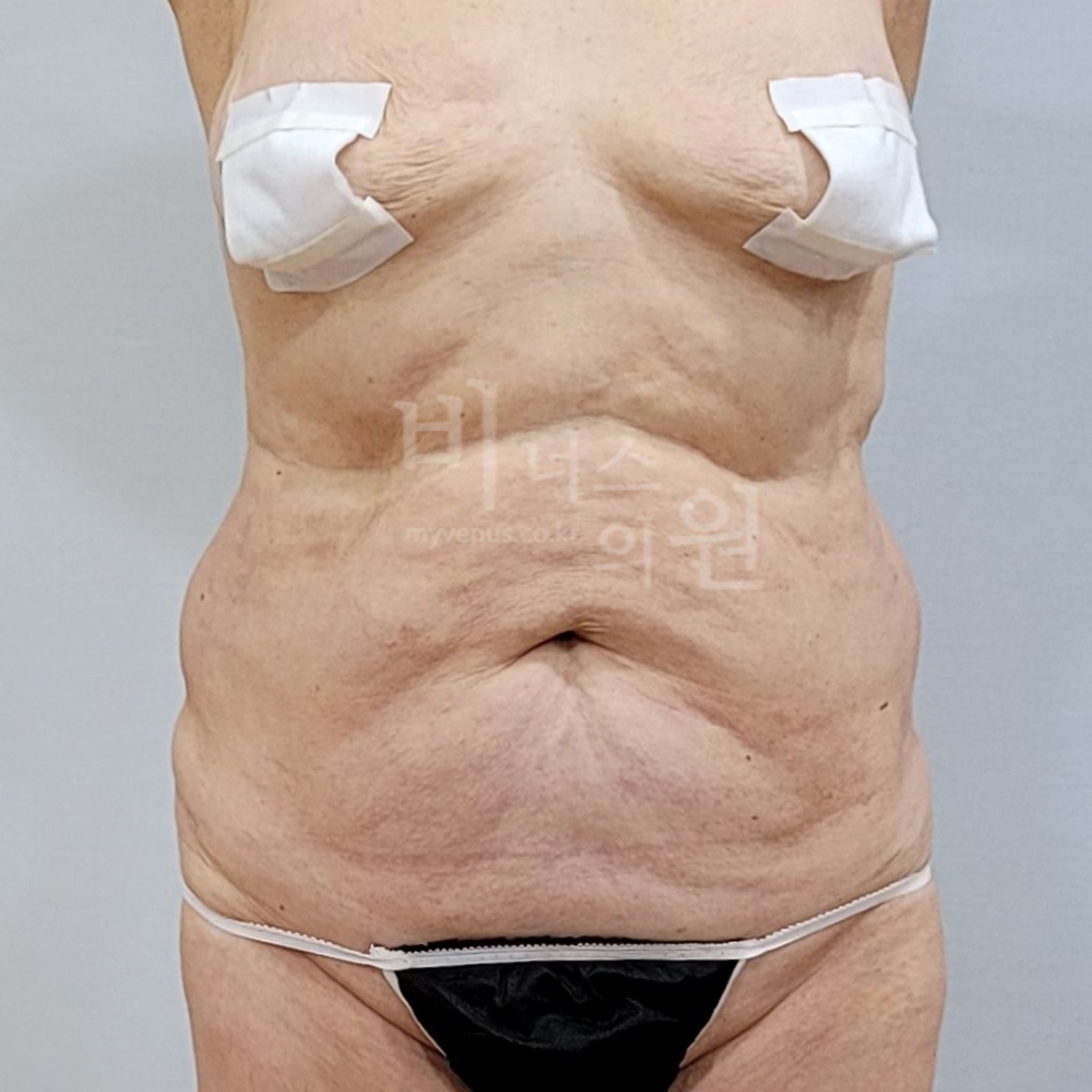 복부 지방흡입 수술전 정면 비너스의원
