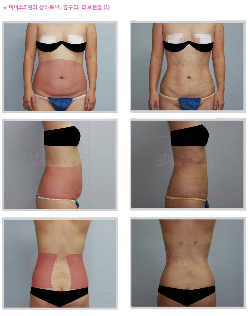 복부지방흡입후기14.jpg