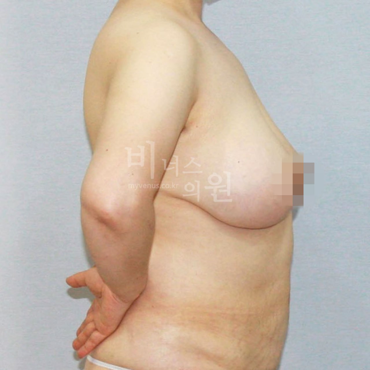 가슴축소수술 전후사진 측면 수술전 비너스의원