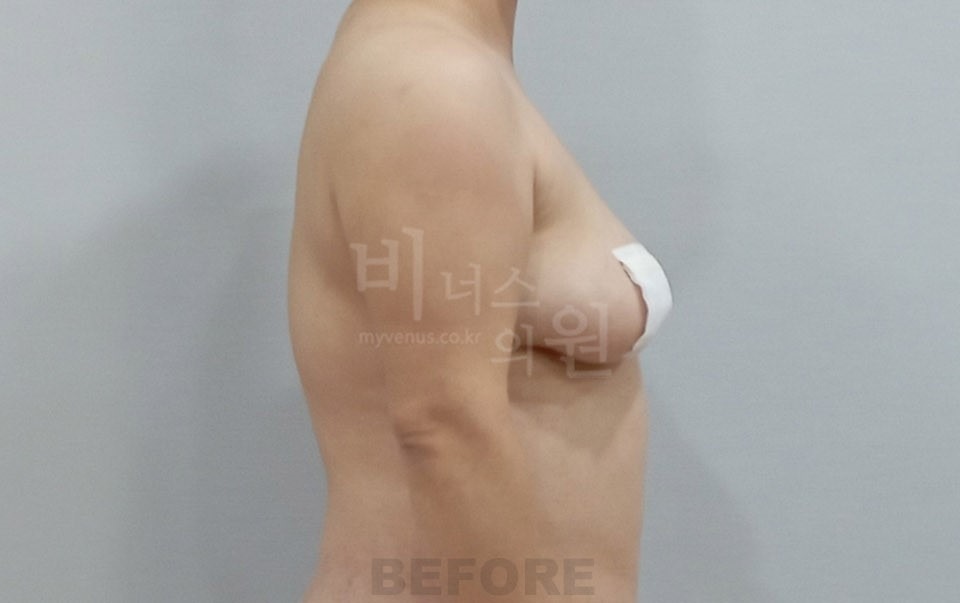 팔 지방흡입 수술 전 측면 ② 비너스의원