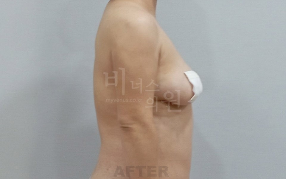 팔 지방흡입 수술 후 측면 ② 비너스의원