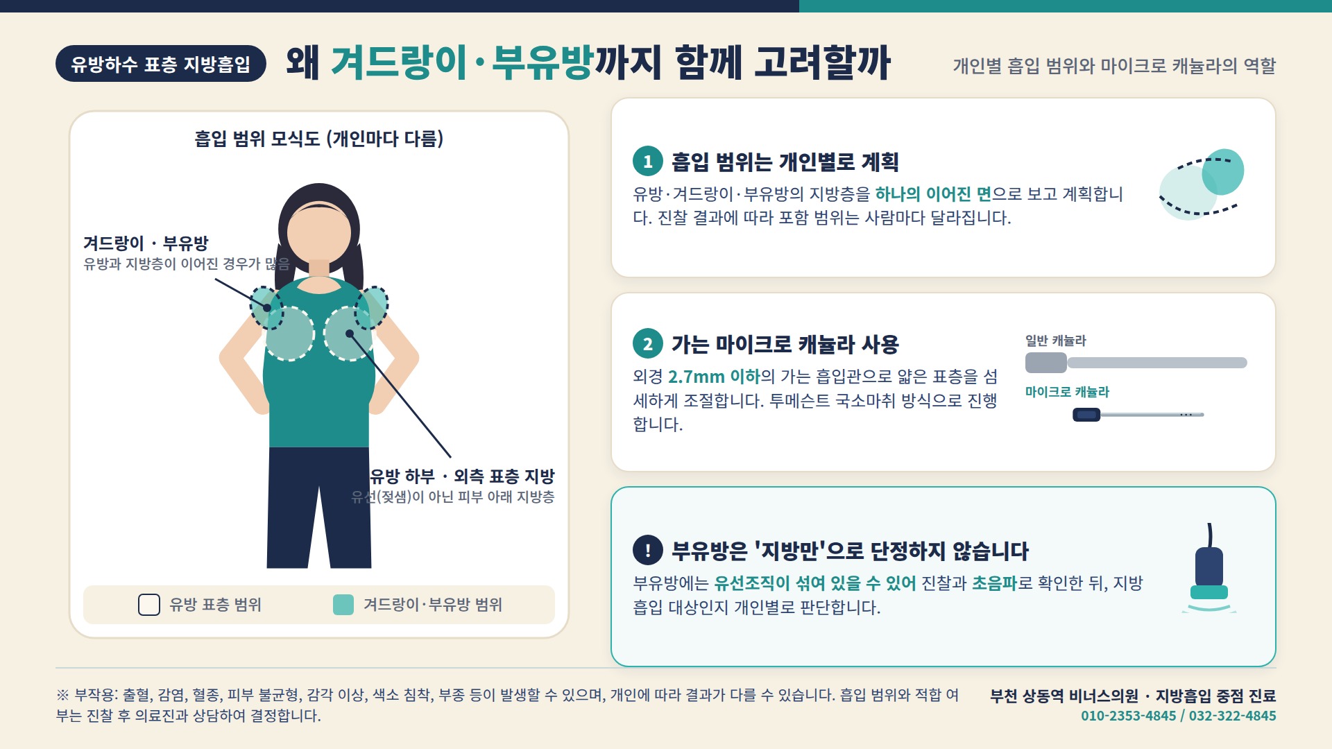 유방하수 표층 지방흡입, 겨드랑이·부유방 흡입 범위와 마이크로 캐뉼라 모식도
