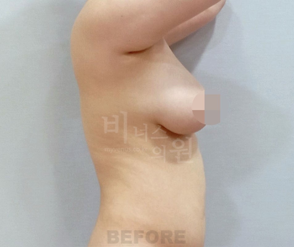 가슴지방흡입_4 - 복사본.JPG