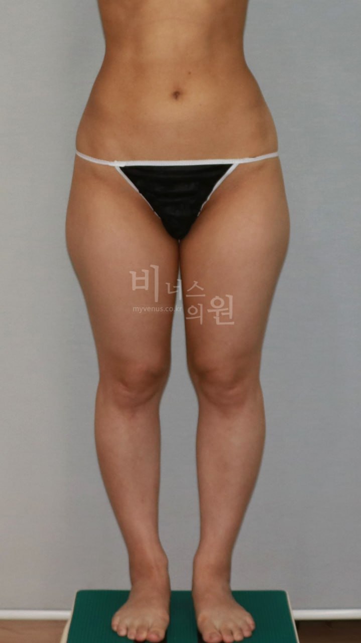 허벅지 지방흡입 수술 전 정면 비너스의원