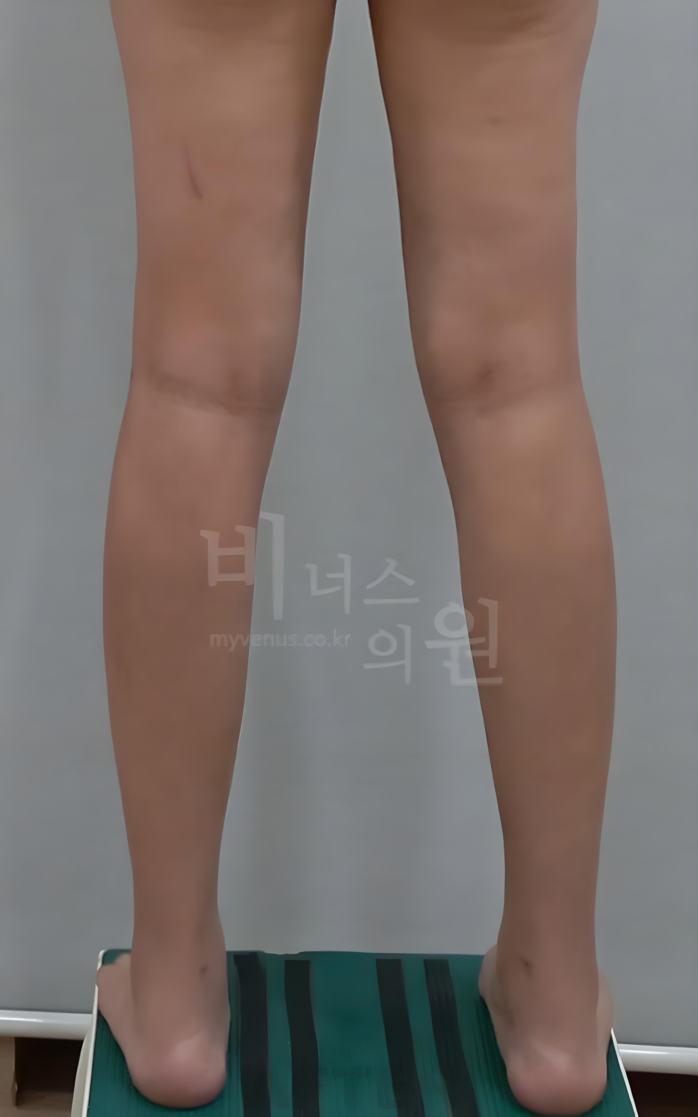 종아리 지방흡입 수술 후 후면 비너스의원