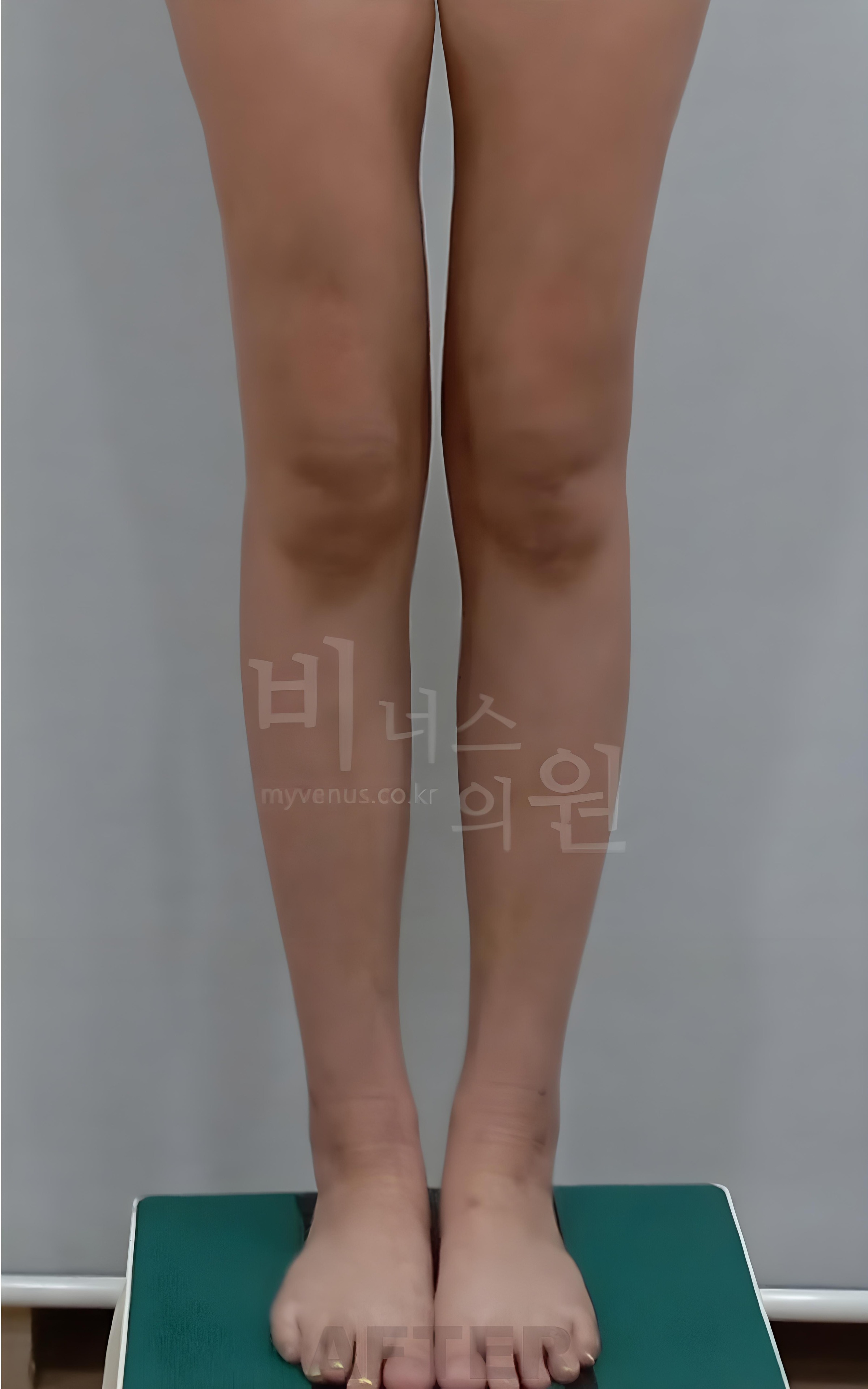 종아리 지방흡입 수술 후 정면 비너스의원