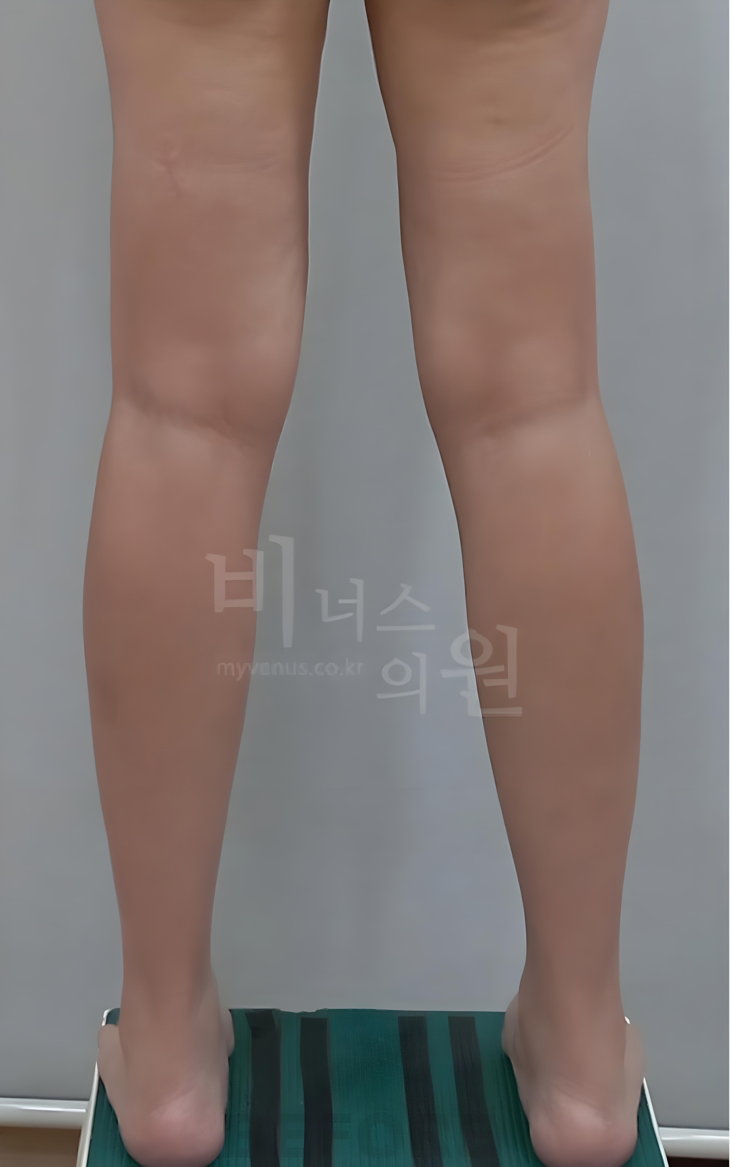 종아리 지방흡입 수술 전 후면 비너스의원