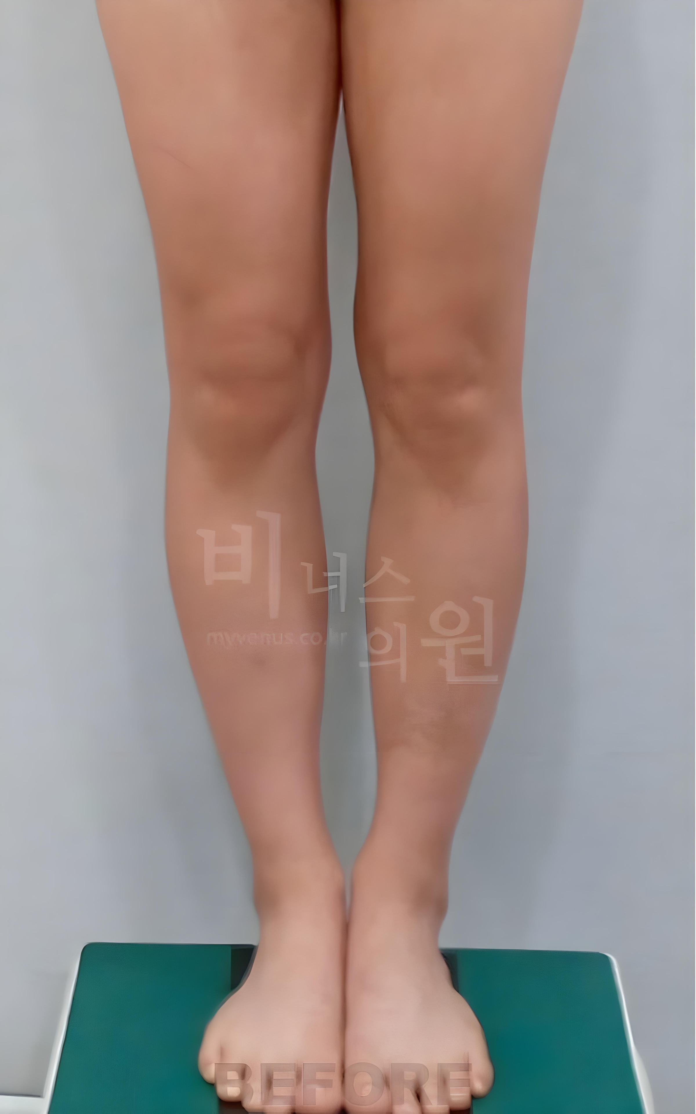 종아리 무릎 안쪽 지방흡입 수술 전 정면 비너스의원