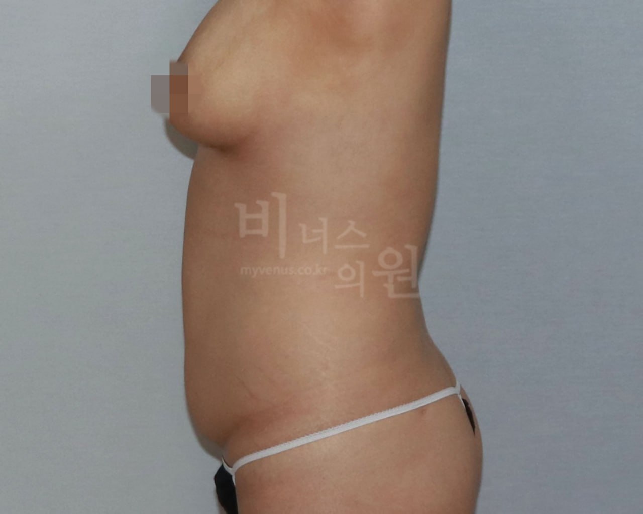 복부 지방흡입 수술 전 측면 비너스의원
