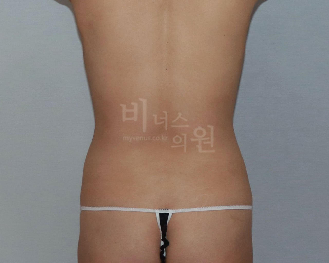 복부 지방흡입 수술 전 후면 비너스의원