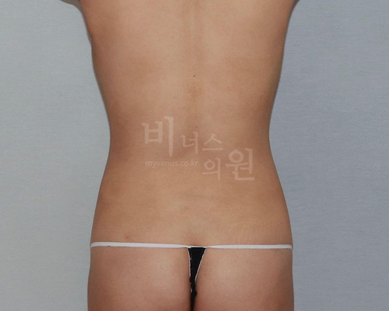 복부 지방흡입 수술 후 후면 비너스의원