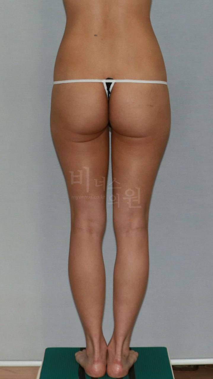 엉덩이 지방흡입 수술 전 후면 비너스의원