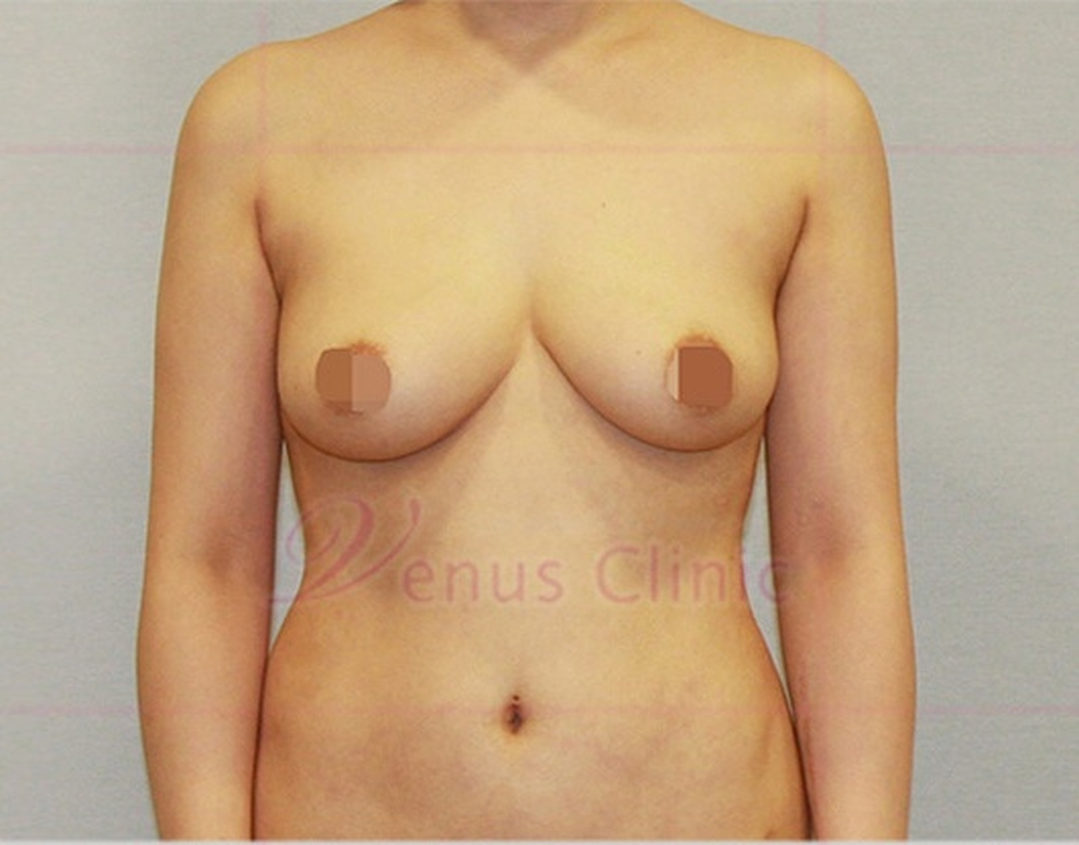 가슴축소 지방흡입 수술 후 정면