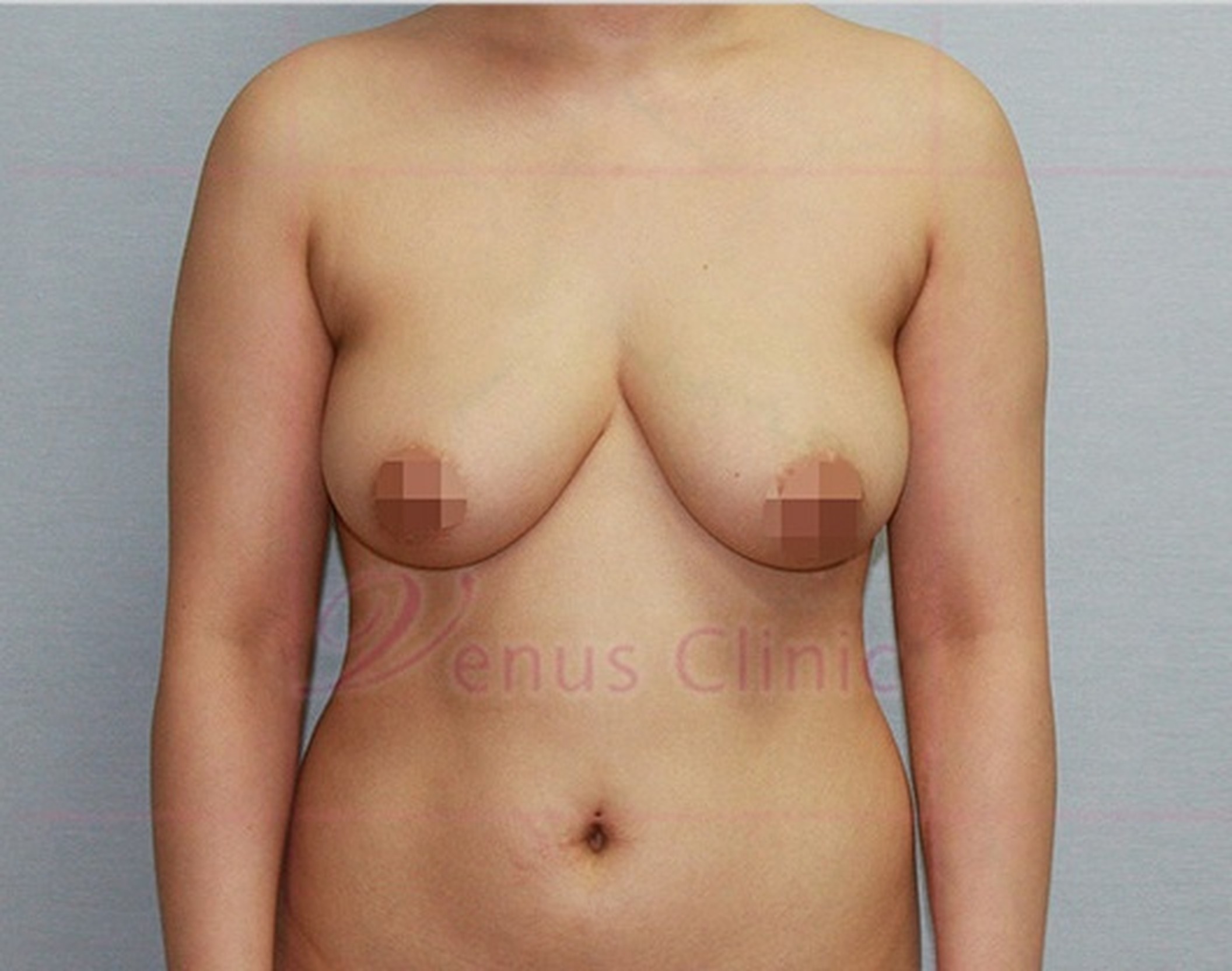 가슴축소 지방흡입 수술 전 정면