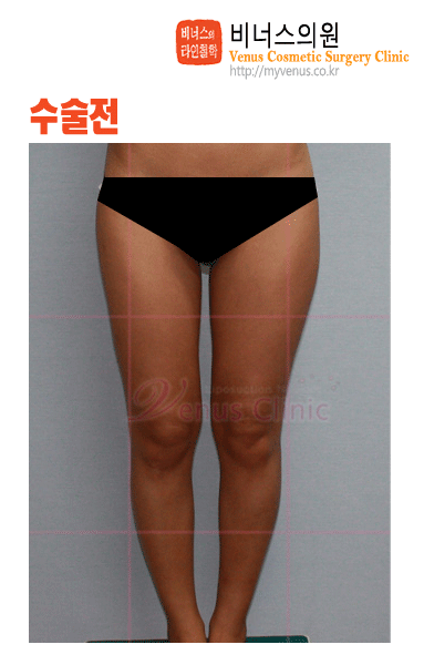 허벅지지방흡입.gif